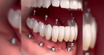 Many Seniors Are Getting Permanent Teeth With This - See Prices