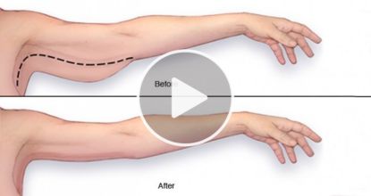 Plastic Surgeon Tells: "Doing This Every Morning Can Snap Back Sagging Skin" (No Creams Needed)